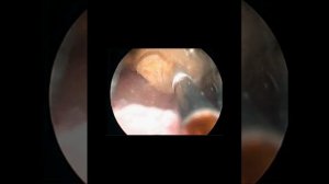 Дробление камня мочевого пузыря (http://urolog-25.ru/)