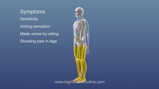 Кокцигодиния - боль в копчике. смотреть онлайн