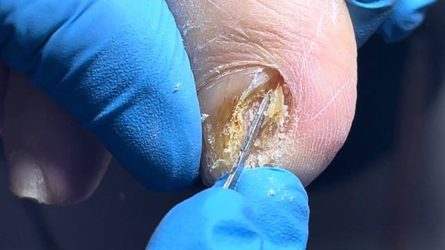 Wow ~ super thick nails, have you ever seen anything thicker than this?【Pedicure Master Lin Jun】 смотреть онлайн