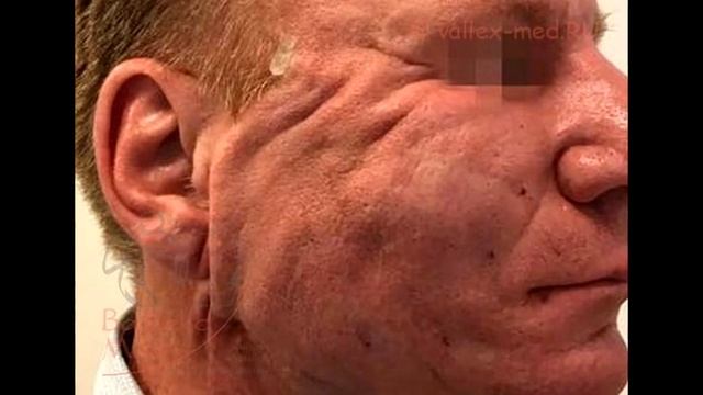 Нити для лица Dr Beauty