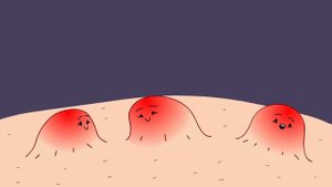 Что Если Никогда НЕ Давить Прыщи ?