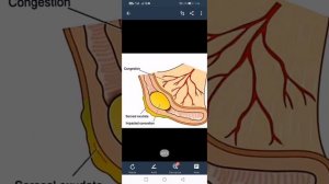 Pathology - APPENDICITIS - GIT (gross, microscopy, jar specimen, notes, mbbs) - HINDI,