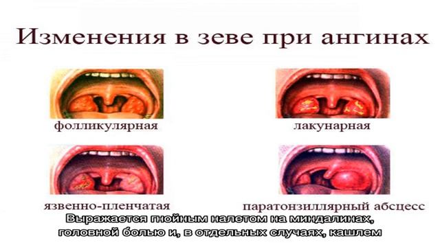 Трубные миндалины