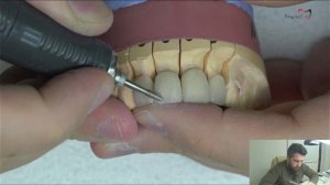 Нанесение керамики emax  на диоксид циркония каркас  Нанесение из 6 масс 4часть