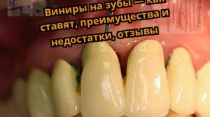 Виниры на зубы — как ставят, преимущества и недостатки, отзывы