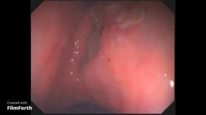 Прижигание язвы желудка, как это происходит