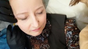 Коррекция височной зоны филлерами с помощью атравматической канюли. Обучение косметологов.