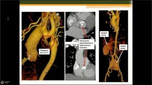 КТ сердца: родом из детства или пороки развития  которые может встретить каждый