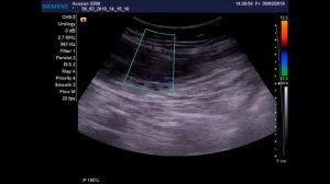 Гематома передней брюшной стенки последствие кашля.