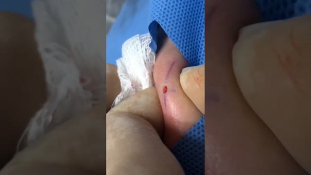 PIERCING MICRODERMAL - COMO APLICAR DE FORMA SEGURA