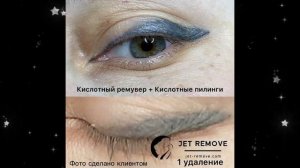 Удаление татуажа ремувером Jet Remove.