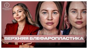 ВЕРХНЯЯ БЛЕФАРОПЛАСТИКА: 3 НЕДЕЛИ