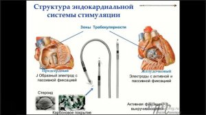 Имплантация кардиостимуляционной системы. Из чего состоит сегодня и что нас ждет завтра?