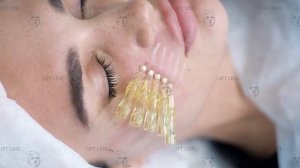 Коррекция носогубных складок нитями Screw Lift Line Nata