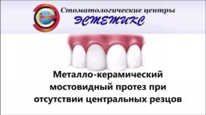 Металлокерамический мостовидный протез при отсутствии центральных резцов