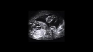 23. Транспозиция магистральных артерий у плода (transposition of the great arteries in fetus)