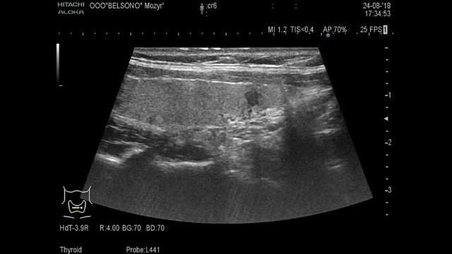 щитовидная железа смотреть онлайн