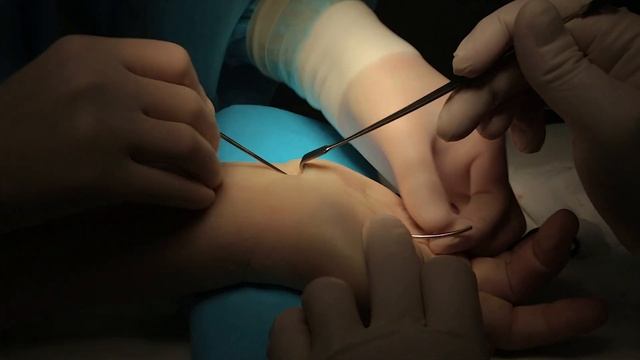 Невролиз и декомпрессия срединного нерва на уровне карпального канала и лацертуса смотреть онлайн