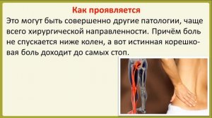 Что нужно знать о радикулопатии