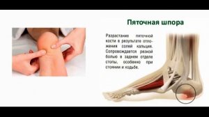 Как быстро избавиться от пяточной шпоры/Болит пятка! Причины боли в пятке/Средства от пяточной шпор