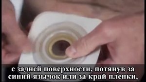 Прикрепление пластины для стомы
