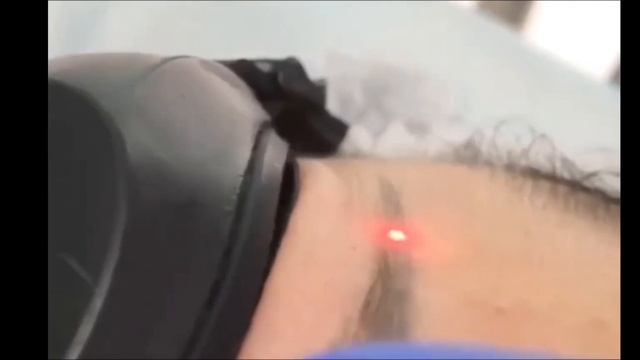 Лазерное удаление татуажа с бровей смотреть онлайн