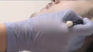 Epilium Лазерная эпиляция области лица у мужчин 1