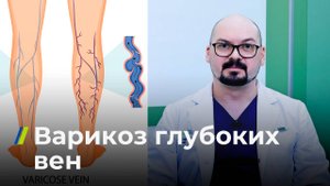 Варикоз глубоких вен: миф или реальность?