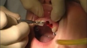 Боли после удаления зуба - Альвеолит