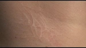 ДЕРМАБРАЗИЯ РУБЦА НА ШЕЕ