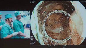 КС 04 ЭГДС при ГПОД ГЭРБ Пищевод Барретта