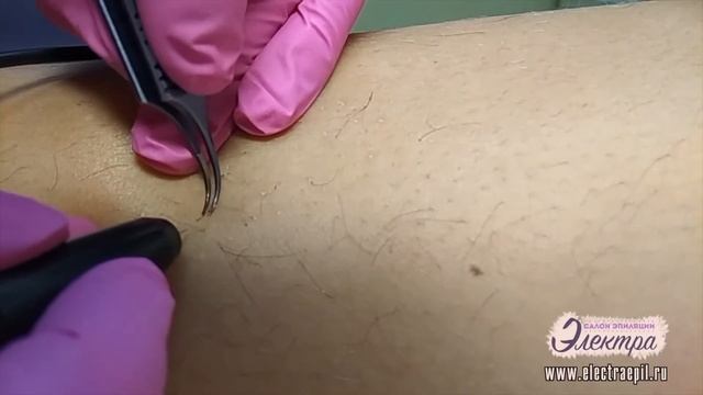 Электроэпиляция голени