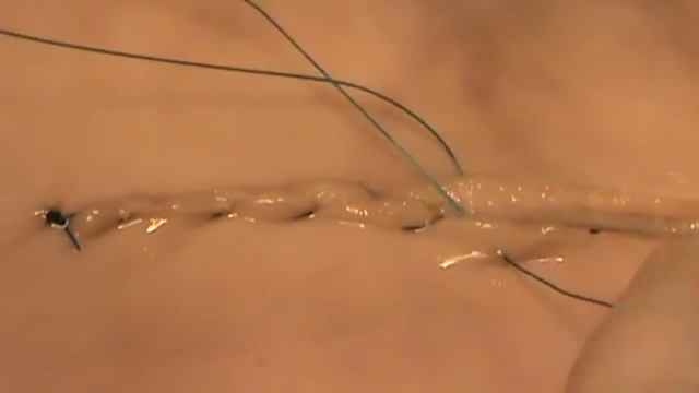 Кишечный шов Шмидена. Docent A.D. Stepanov, ПДАТУ смотреть онлайн