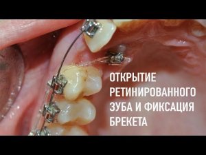Открытие ретинированного зуба и фиксация брекета | операция на ретинированном зубе