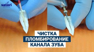 Чистка и пломбирование канала зуба
