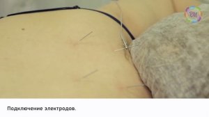 Электроакупунктура — Иглорефлексотерапия (ЭАП) | Процедура Роял Медик