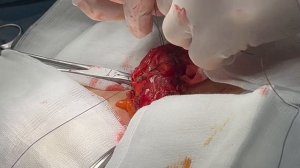 Закрытие колостомы (трансверзостомы). Loop colostomy closure.