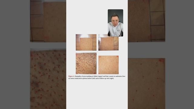 Диодный лазер и сочетание разных длин волн смотреть онлайн