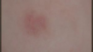 Шершавые пятна на коже