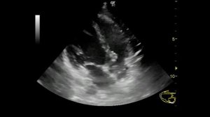 тахикардия и эхокардиография