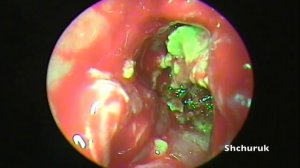 Fungal bodies sphenoid sinus