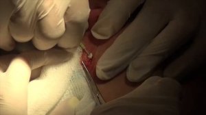 Нитевой лифтинг лица и шеи