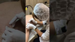 Лечение базальноклеточного рака кожи. Лазерное удаление