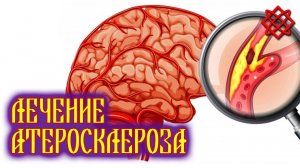 КАК ВЫЛЕЧИТЬ АТЕРОСКЛЕРОЗ. Лечение Сосудов без Лекарств. Сборы Трав От Лишнего Веса.mp4