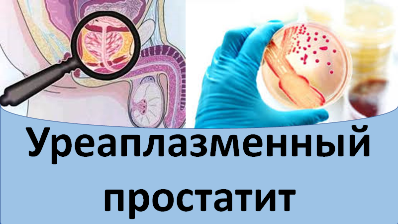 Уреаплазменный простатит.