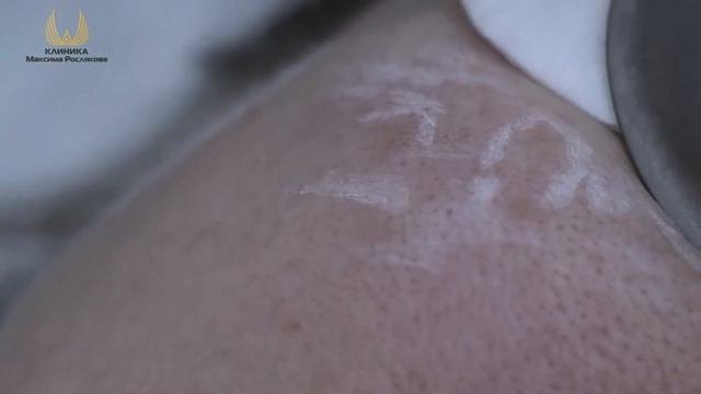 Удаление гиперпигментации