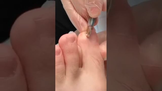 Professional ingrown toenail trimming~ #pedicure