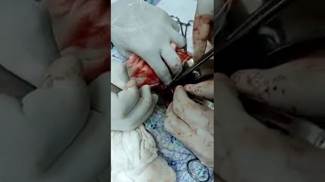 Удаление огромной кисты яичника с оставлением яичника.
