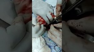 Удаление огромной кисты яичника с оставлением яичника.