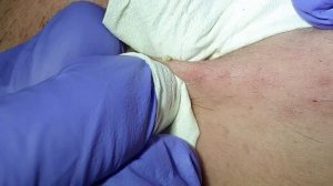 BLACKHEADS EXTRACTIONS on Happy :) #10